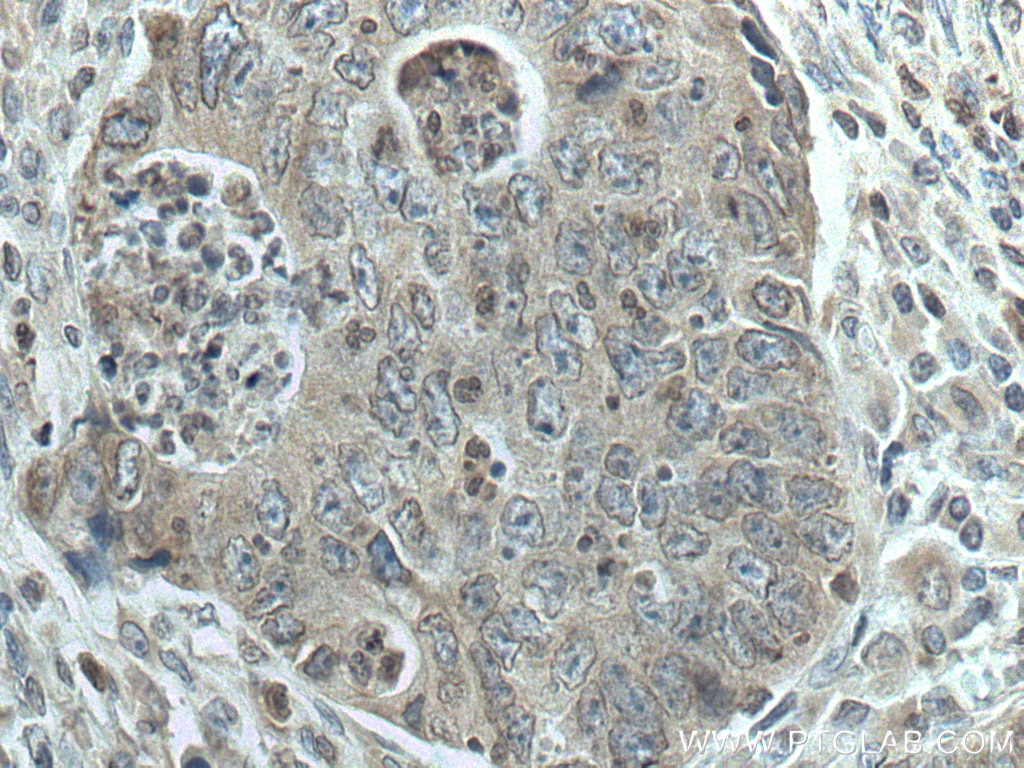 Immunohistochemistry (IHC) staining of human colon cancer tissue using SPTLC1 Monoclonal antibody (66899-1-Ig)