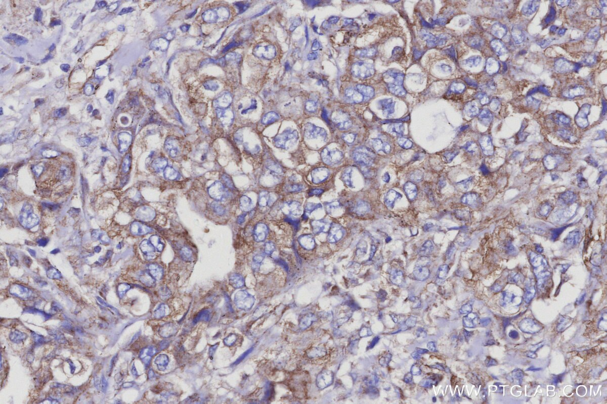 IHC staining of human pancreas cancer using 68094-1-Ig Immunohistochemistry (IHC) staining of human pancreas cancer tissue using SPTLC2 Monoclonal antibody (68094-1-Ig)