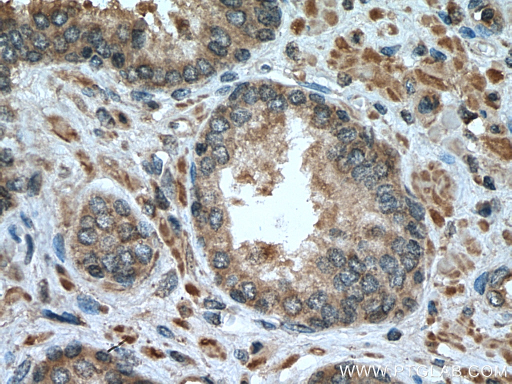 Immunohistochemistry (IHC) staining of human prostate cancer tissue using SQLE Polyclonal antibody (12544-1-AP)
