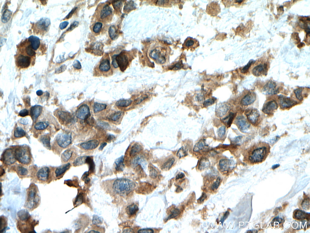 Immunohistochemistry (IHC) staining of human breast cancer tissue using SQLE Polyclonal antibody (12544-1-AP)