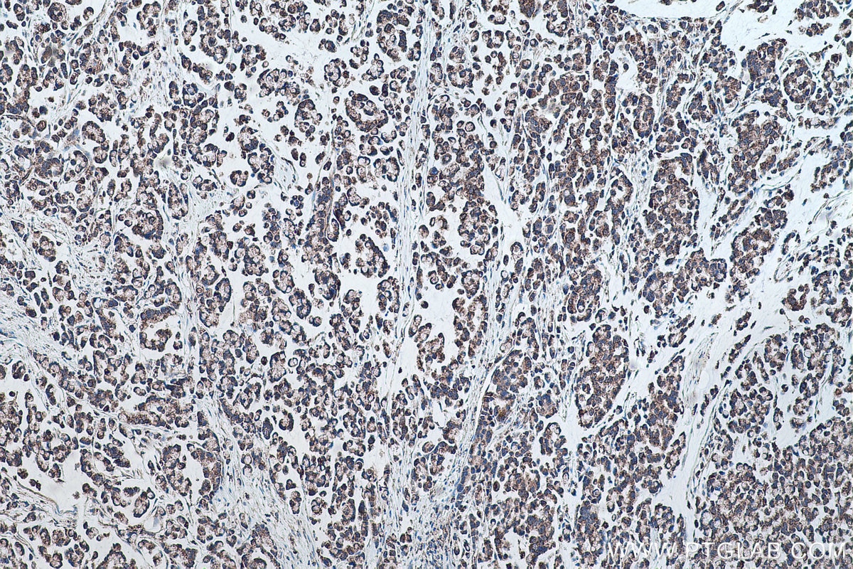 Immunohistochemistry (IHC) staining of human colon cancer tissue using SQRDL Polyclonal antibody (17256-1-AP)