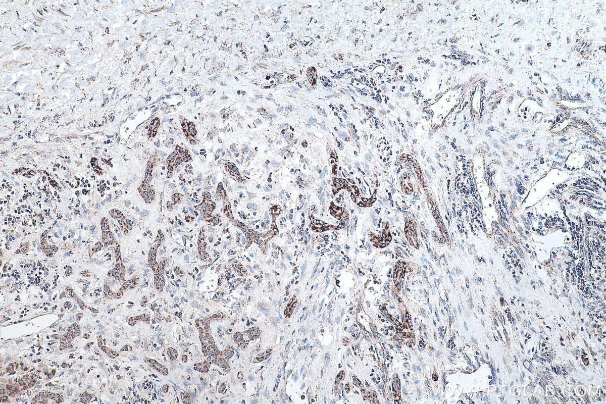 Immunohistochemistry (IHC) staining of human liver cancer tissue using SQRDL Polyclonal antibody (17256-1-AP)