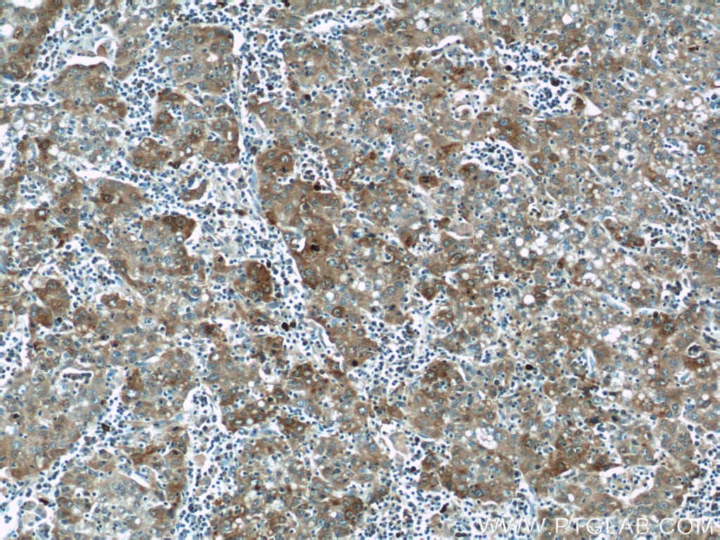 Immunohistochemistry (IHC) staining of human liver cancer tissue using P62,SQSTM1 Polyclonal antibody (18420-1-AP)