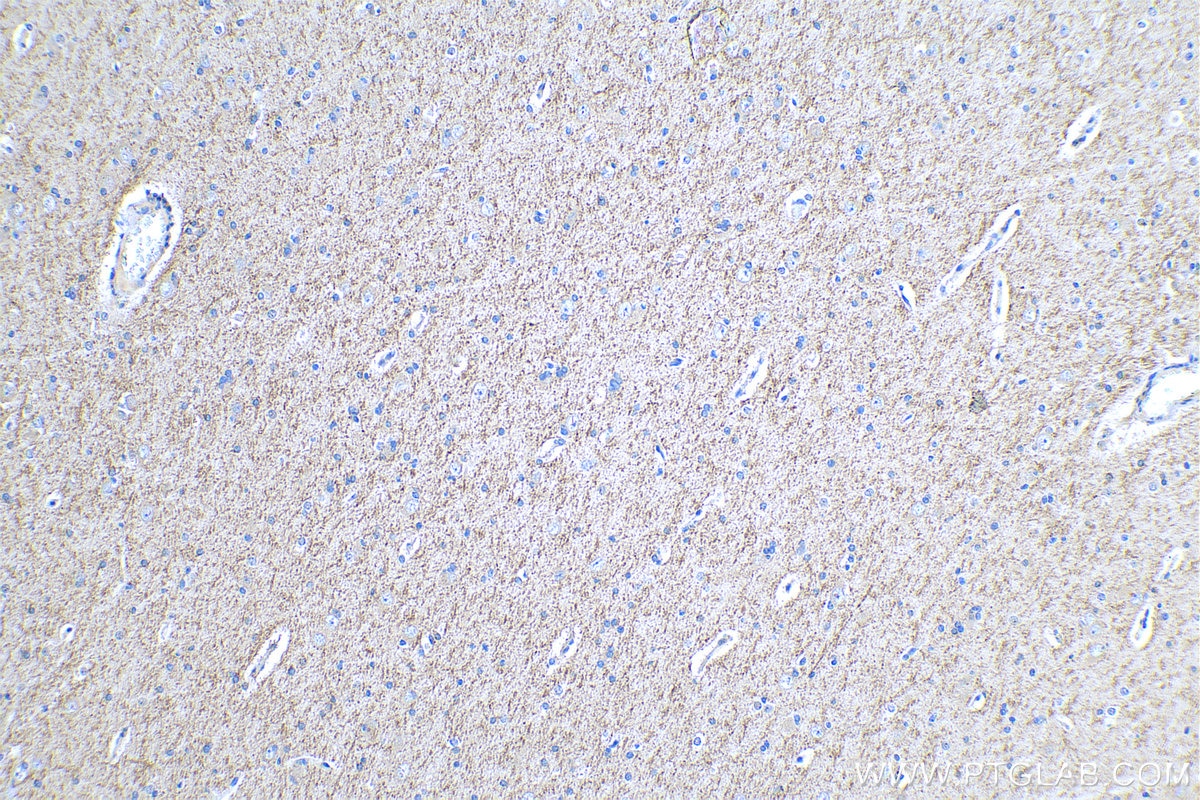 Immunohistochemistry (IHC) staining of human gliomas tissue using P62,SQSTM1 Polyclonal antibody (18420-1-AP)