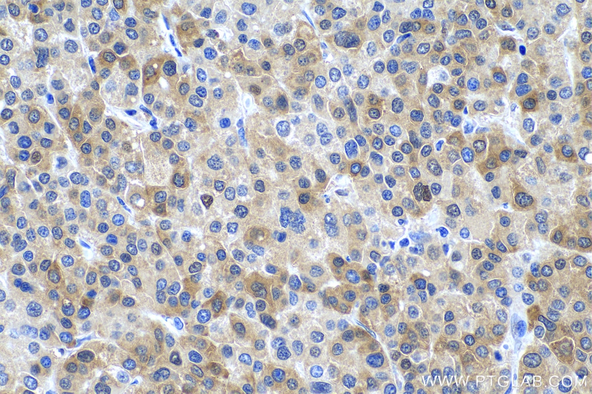 Immunohistochemistry (IHC) staining of human liver cancer tissue using P62,SQSTM1 Polyclonal antibody (18420-1-AP)