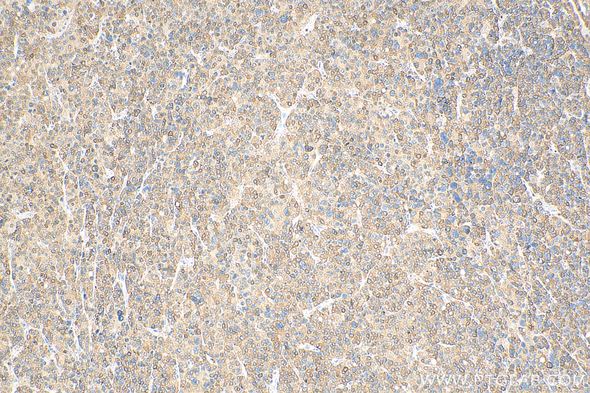 Immunohistochemistry (IHC) staining of human liver cancer tissue using P62,SQSTM1 Polyclonal antibody (18420-1-AP)