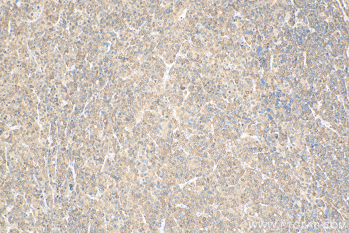 IHC staining of human liver cancer using 18420-1-AP