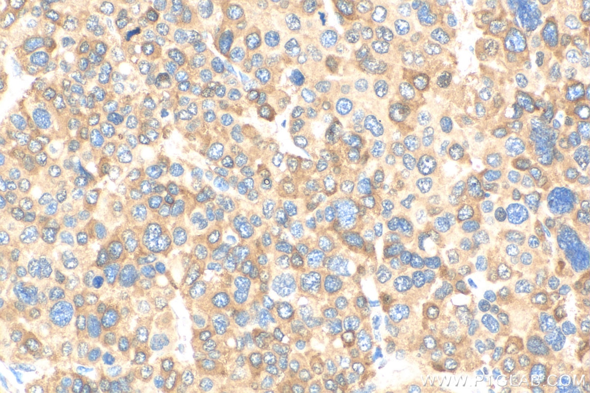 Immunohistochemistry (IHC) staining of human liver cancer tissue using P62,SQSTM1 Polyclonal antibody (18420-1-AP)
