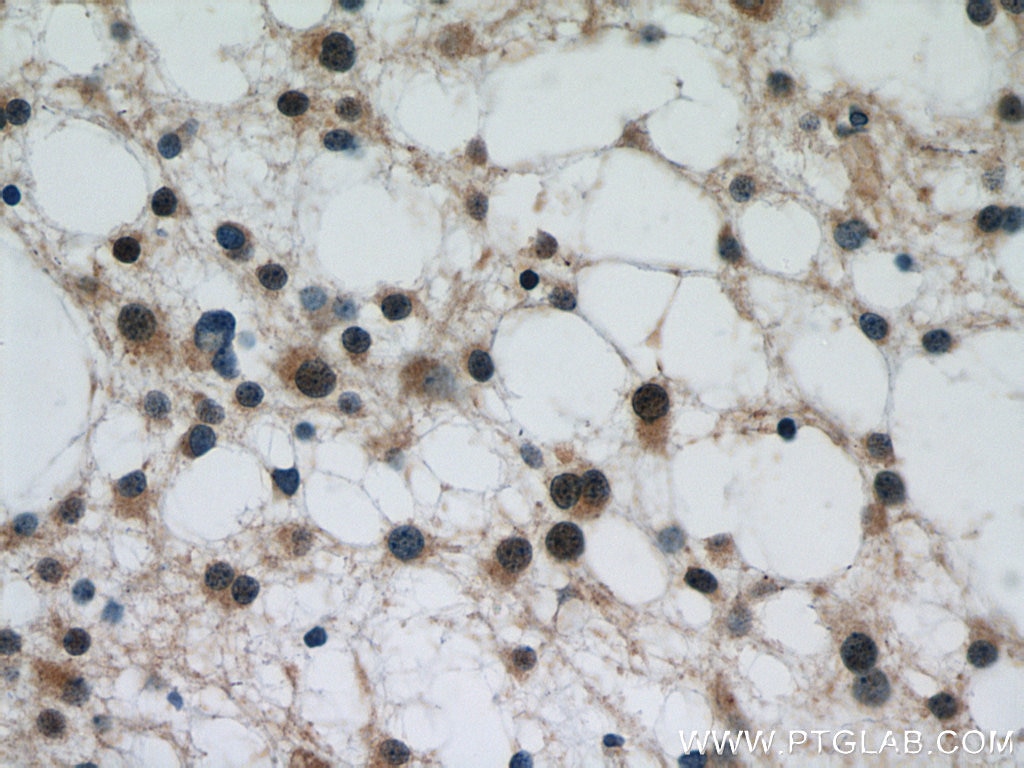 Immunohistochemistry (IHC) staining of human gliomas tissue using P62,SQSTM1 Polyclonal antibody (18420-1-AP)