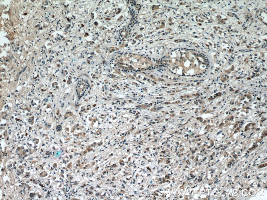 Immunohistochemistry (IHC) staining of human breast cancer tissue using P62/SQSTM1 Polyclonal antibody (55274-1-AP)