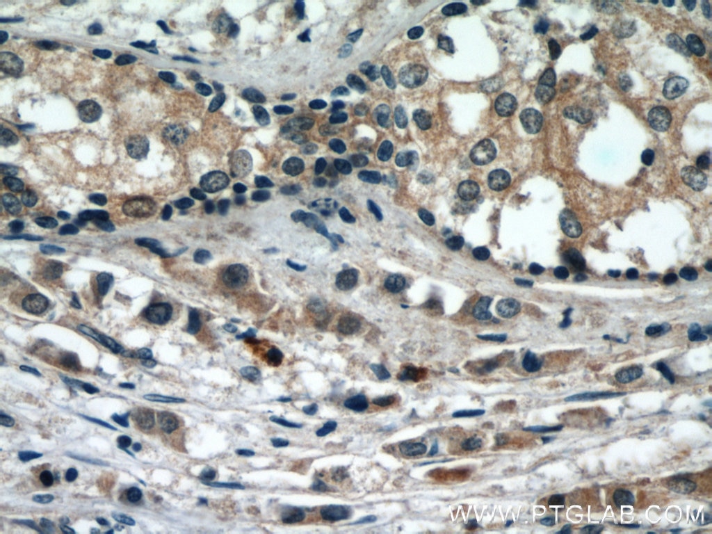 Immunohistochemistry (IHC) staining of human breast cancer tissue using P62/SQSTM1 Polyclonal antibody (55274-1-AP)