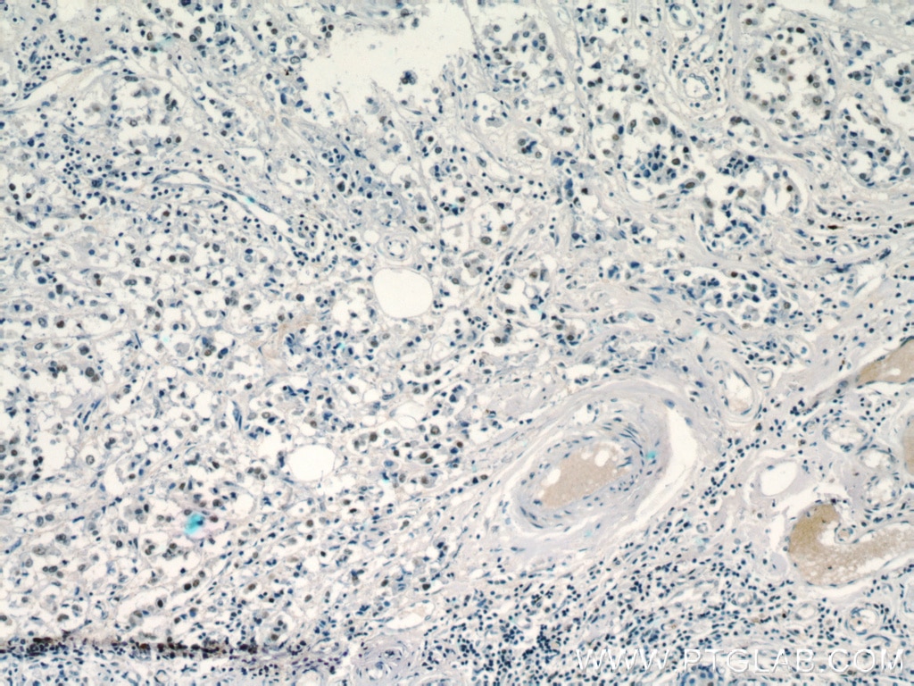 Immunohistochemistry (IHC) staining of human breast cancer tissue using SR140 Polyclonal antibody (21399-1-AP)