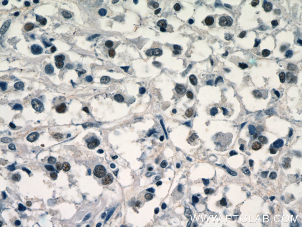 Immunohistochemistry (IHC) staining of human breast cancer tissue using SR140 Polyclonal antibody (21399-1-AP)