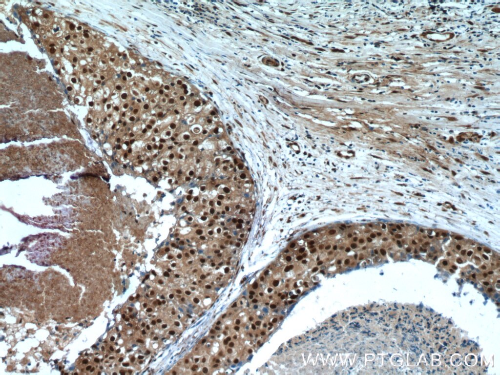 Immunohistochemistry (IHC) staining of human breast cancer tissue using SRA1 Polyclonal antibody (24655-1-AP)
