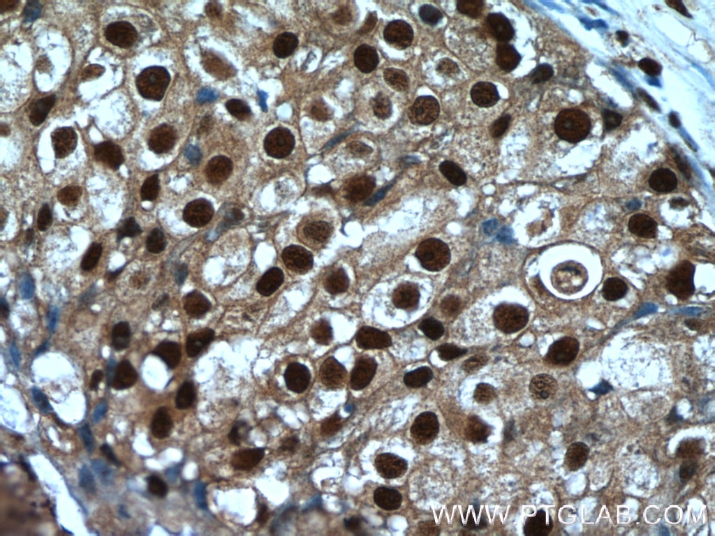 Immunohistochemistry (IHC) staining of human breast cancer tissue using SRA1 Polyclonal antibody (24655-1-AP)