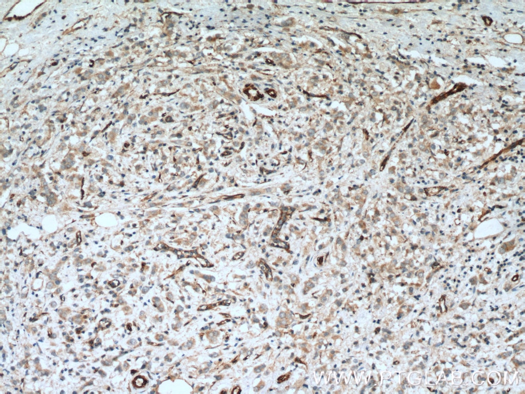 Immunohistochemistry (IHC) staining of human breast cancer tissue using c-SRC Polyclonal antibody (11097-1-AP)