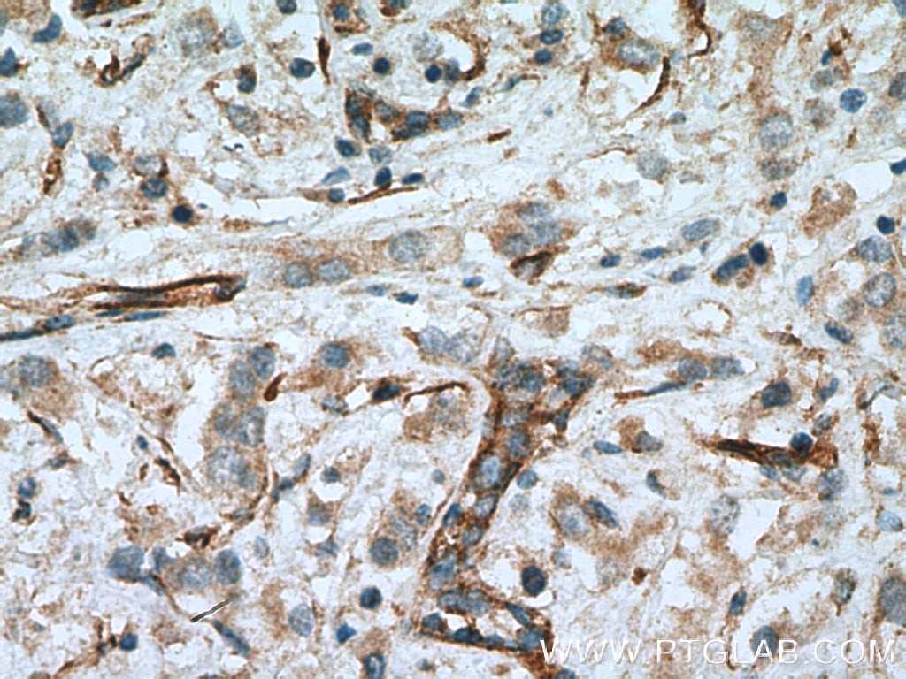 Immunohistochemistry (IHC) staining of human breast cancer tissue using c-SRC Polyclonal antibody (11097-1-AP)