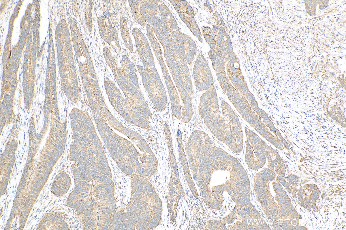Immunohistochemistry (IHC) staining of human colon cancer tissue using SRD5A1 Polyclonal antibody (26001-1-AP)