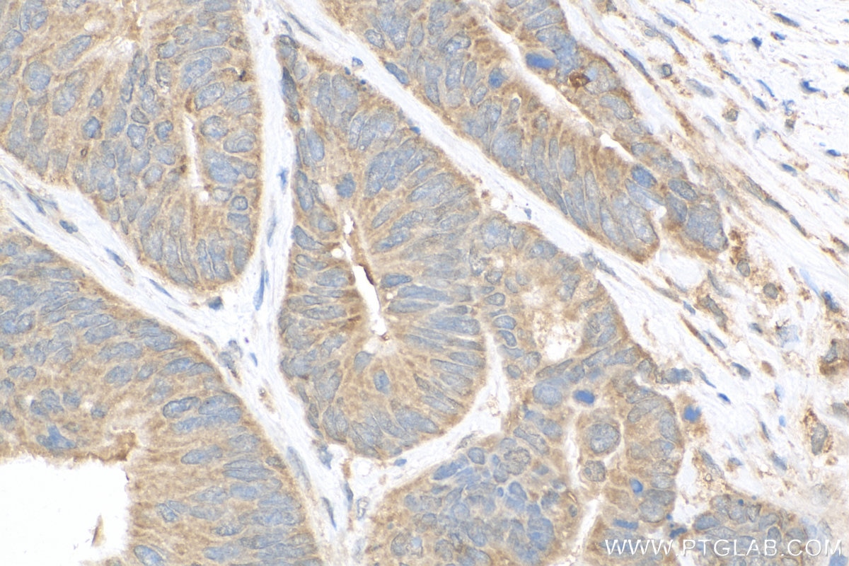 Immunohistochemistry (IHC) staining of human colon cancer tissue using SRD5A1 Polyclonal antibody (26001-1-AP)