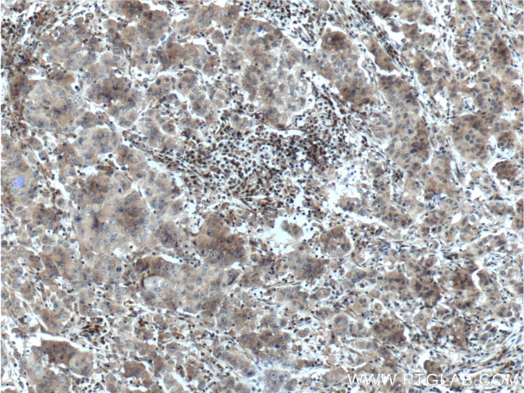 Immunohistochemistry (IHC) staining of human prostate cancer tissue using SRD5A1 Polyclonal antibody (26001-1-AP)