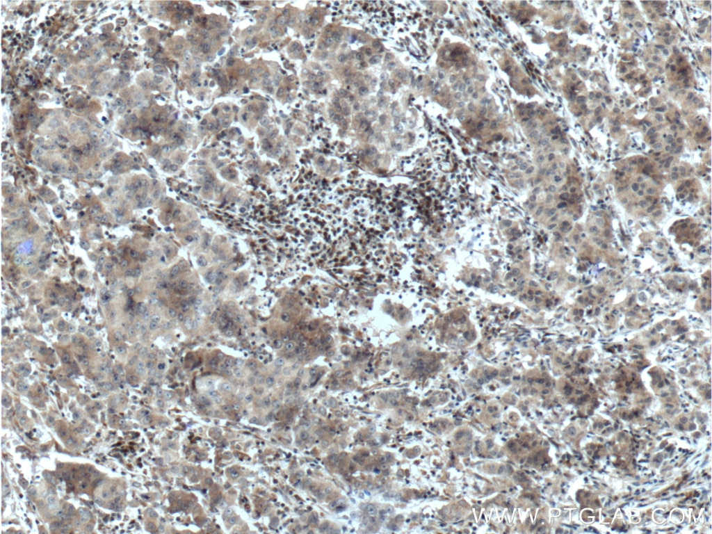 IHC staining of human prostate cancer using 26001-1-AP