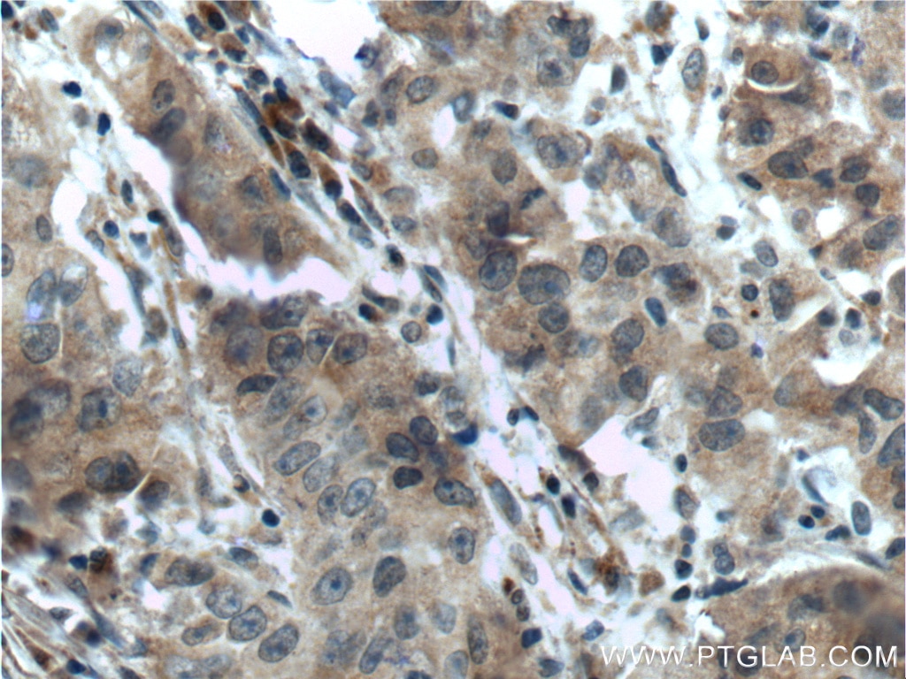 Immunohistochemistry (IHC) staining of human prostate cancer tissue using SRD5A1 Polyclonal antibody (26001-1-AP)