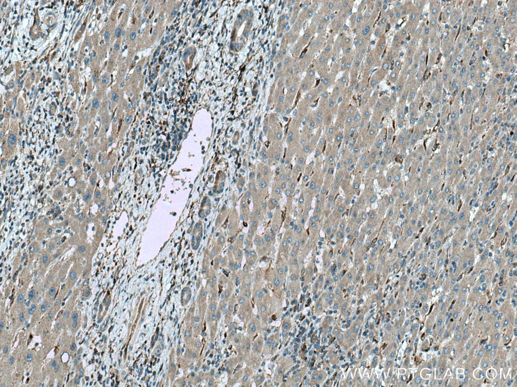 IHC staining of human liver cancer using 14508-1-AP