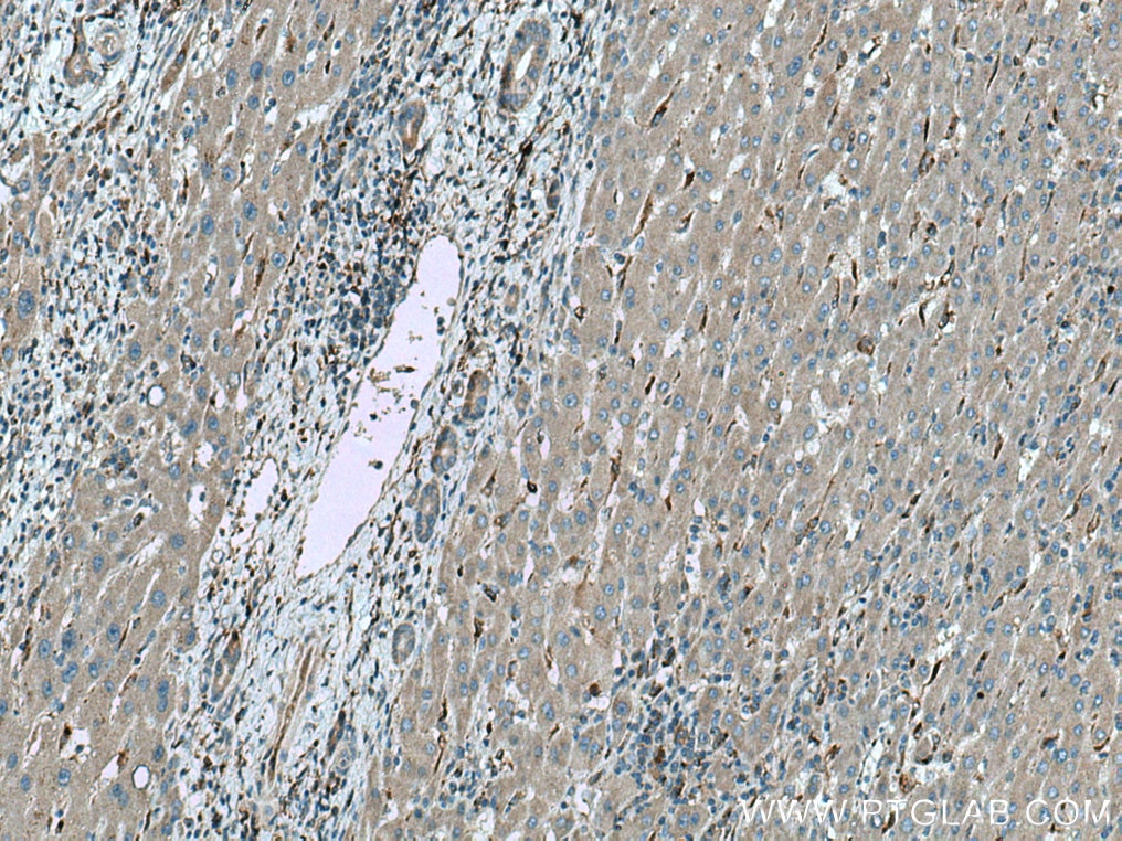 Immunohistochemistry (IHC) staining of human liver cancer tissue using SREBF2 Polyclonal antibody (14508-1-AP)