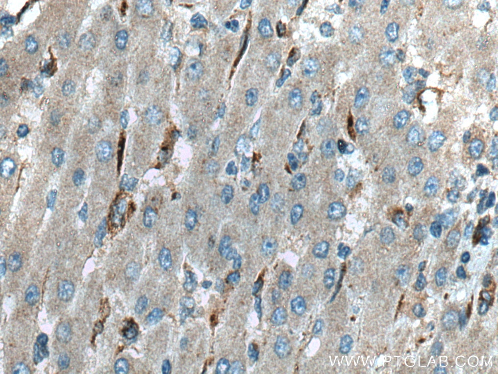 Immunohistochemistry (IHC) staining of human liver cancer tissue using SREBF2 Polyclonal antibody (14508-1-AP)