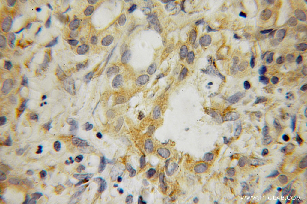 Immunohistochemistry (IHC) staining of human pancreas cancer tissue using SRFBP1 Polyclonal antibody (12792-1-AP)