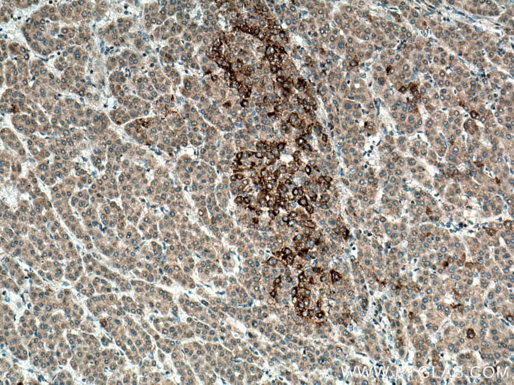 IHC staining of human liver cancer using 13252-1-AP