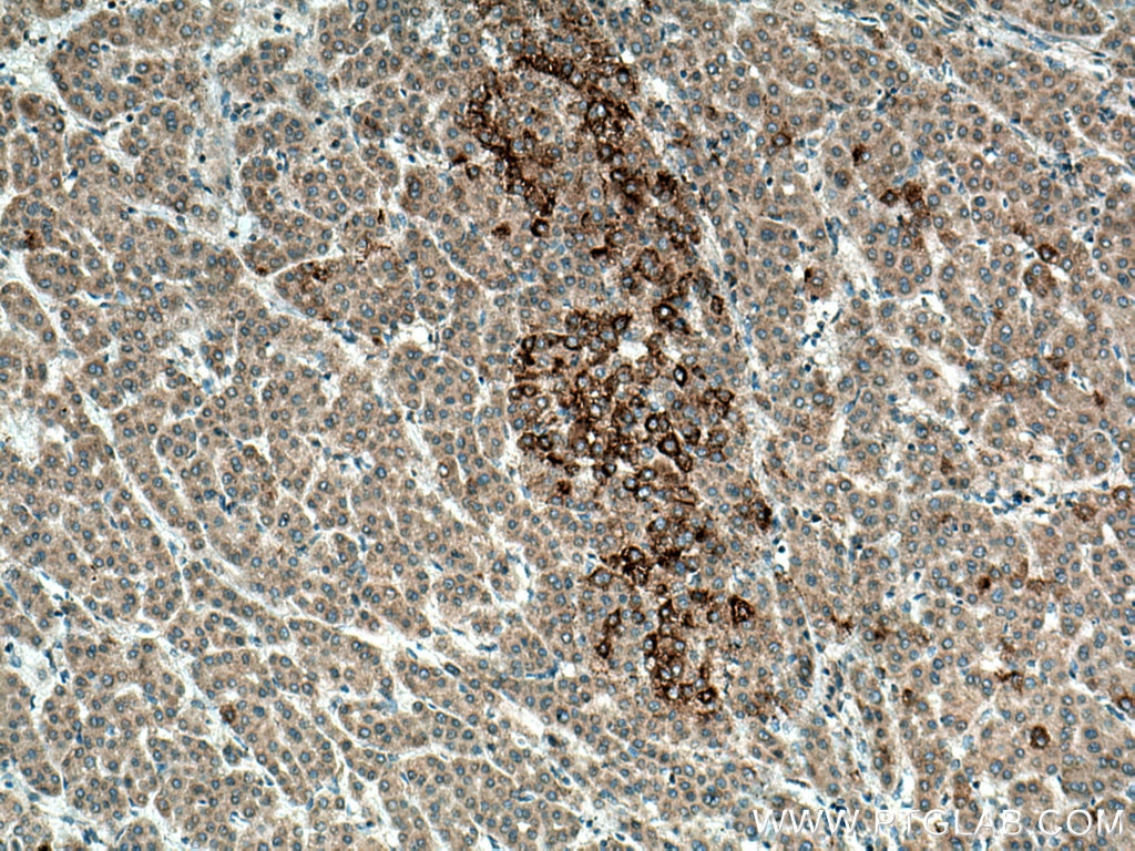 Immunohistochemistry (IHC) staining of human liver cancer tissue using SRGAP1 Polyclonal antibody (13252-1-AP)