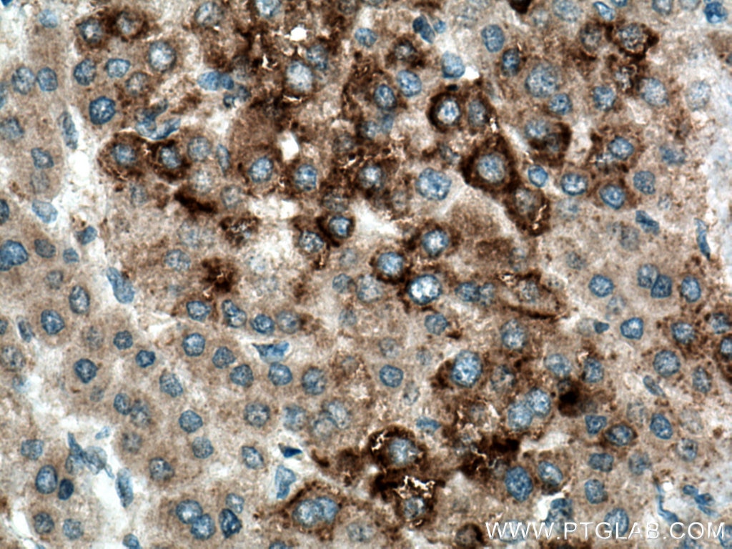 Immunohistochemistry (IHC) staining of human liver cancer tissue using SRGAP1 Polyclonal antibody (13252-1-AP)