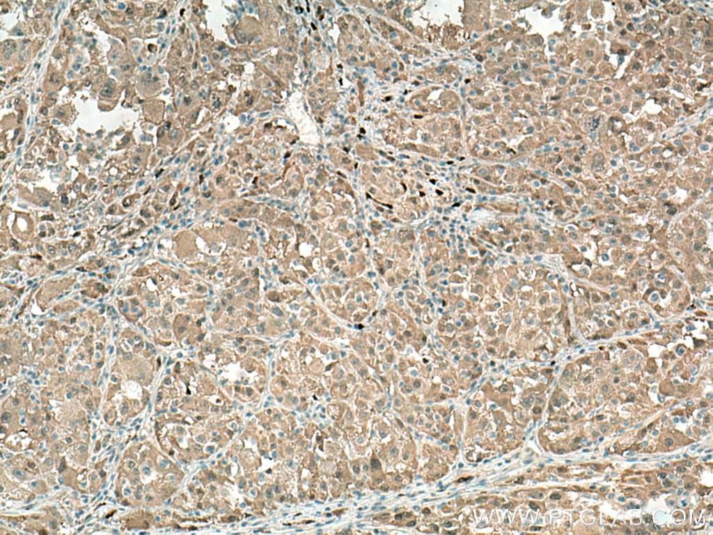 Immunohistochemistry (IHC) staining of human liver cancer tissue using Spermidine synthase Polyclonal antibody (19858-1-AP)