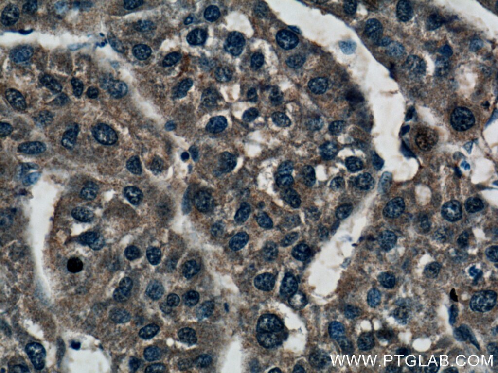 Immunohistochemistry (IHC) staining of human liver cancer tissue using Spermidine synthase Polyclonal antibody (19858-1-AP)