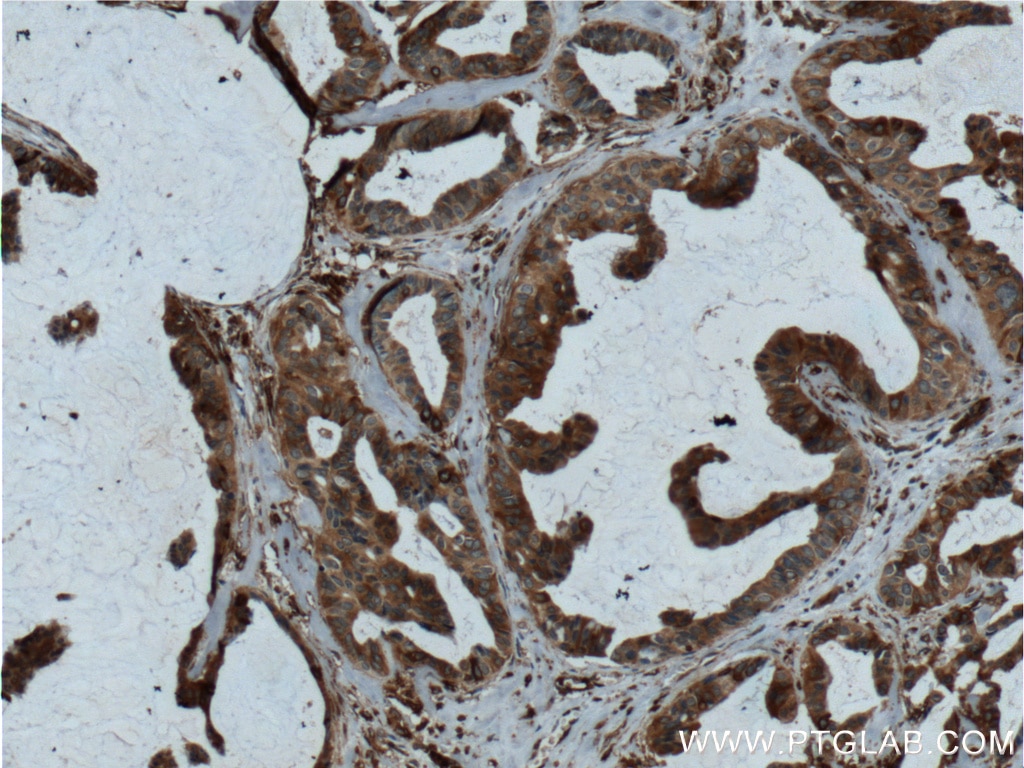 IHC staining of human breast cancer using 26447-1-AP