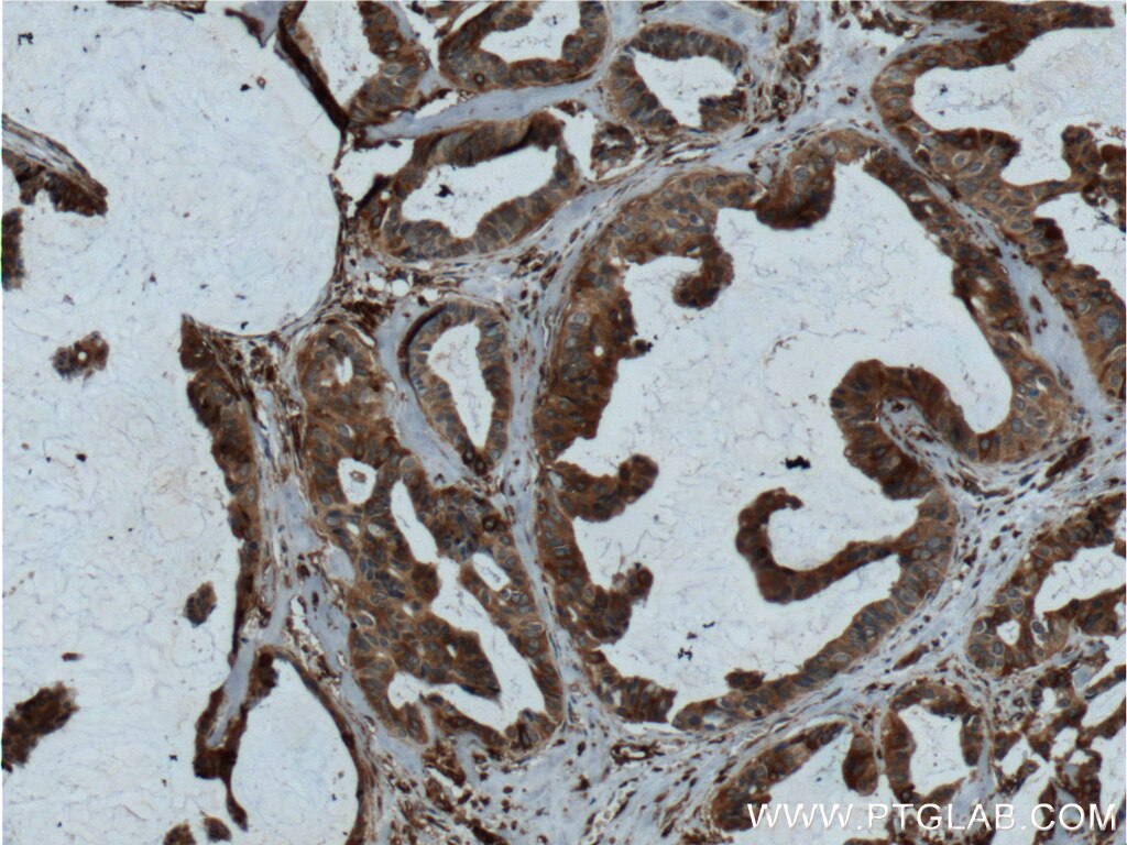 Immunohistochemistry (IHC) staining of human breast cancer tissue using SRMS Polyclonal antibody (26447-1-AP)