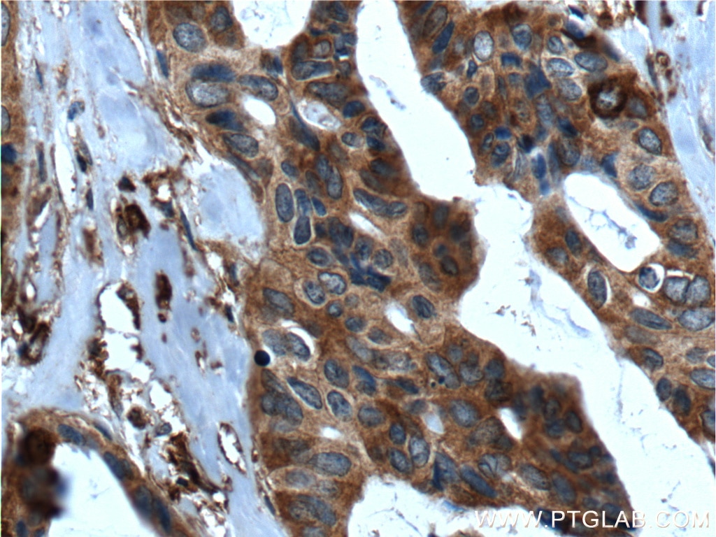 Immunohistochemistry (IHC) staining of human breast cancer tissue using SRMS Polyclonal antibody (26447-1-AP)