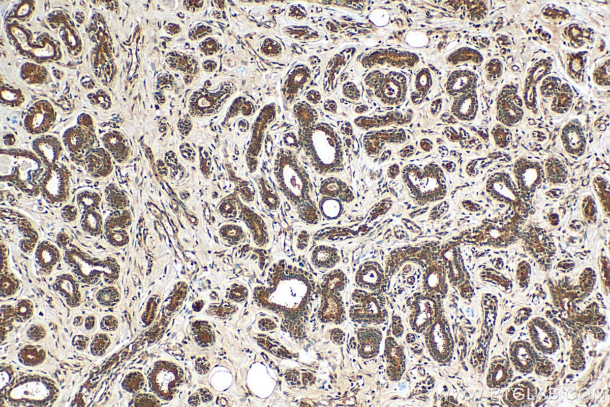 Immunohistochemistry (IHC) staining of human breast cancer tissue using SRP54 Polyclonal antibody (11729-1-AP)