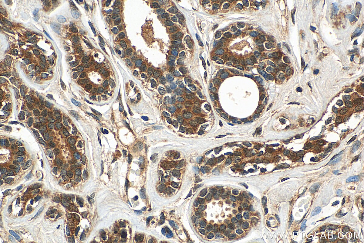 Immunohistochemistry (IHC) staining of human breast cancer tissue using SRP54 Polyclonal antibody (11729-1-AP)