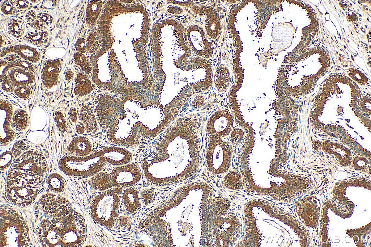 Immunohistochemistry (IHC) staining of human breast cancer tissue using SRP54 Polyclonal antibody (11729-1-AP)