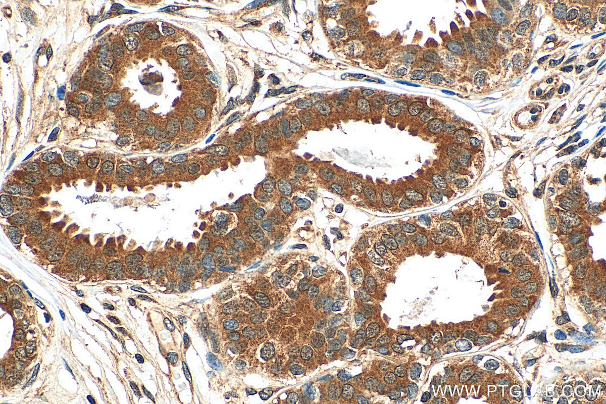 Immunohistochemistry (IHC) staining of human breast cancer tissue using SRP54 Polyclonal antibody (11729-1-AP)
