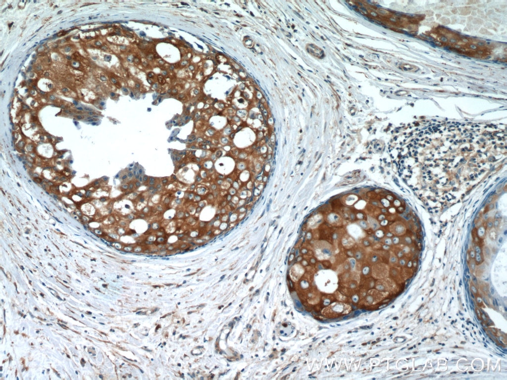 Immunohistochemistry (IHC) staining of human breast cancer tissue using SRP54 Polyclonal antibody (17976-1-AP)