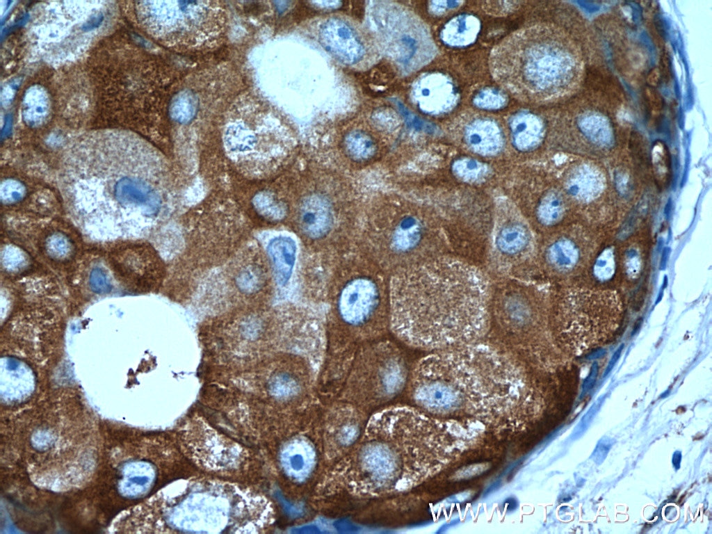 Immunohistochemistry (IHC) staining of human breast cancer tissue using SRP54 Polyclonal antibody (17976-1-AP)