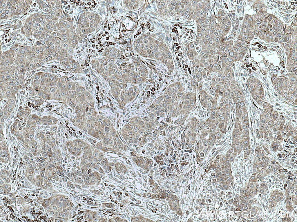 IHC staining of human breast cancer using 67005-1-Ig