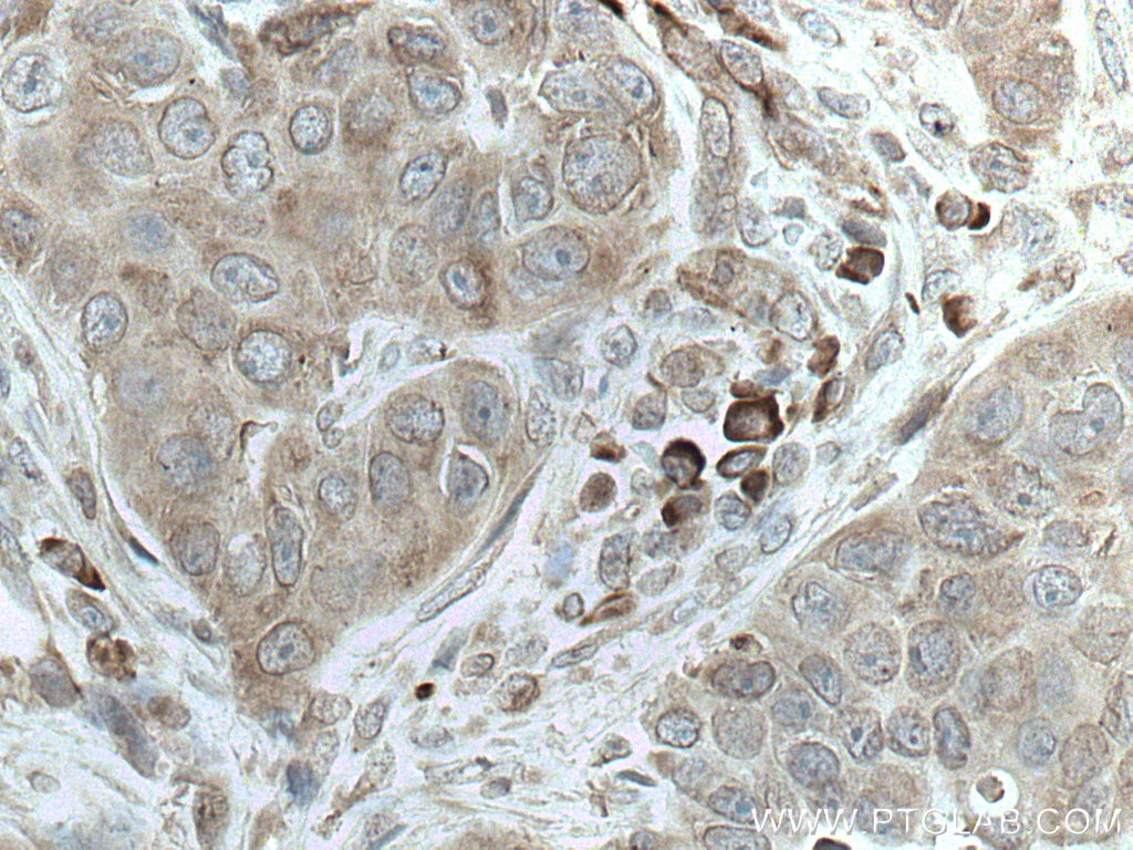 Immunohistochemistry (IHC) staining of human breast cancer tissue using SRP54 Monoclonal antibody (67005-1-Ig)
