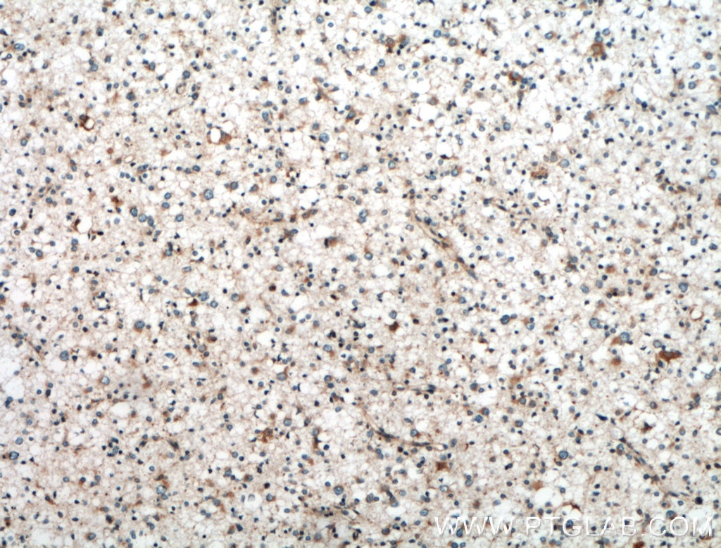 Immunohistochemistry (IHC) staining of human gliomas tissue using SRP68 Polyclonal antibody (11585-1-AP)