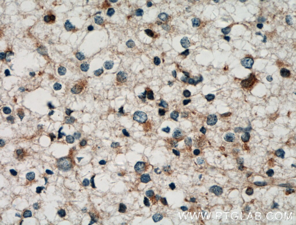 Immunohistochemistry (IHC) staining of human gliomas tissue using SRP68 Polyclonal antibody (11585-1-AP)