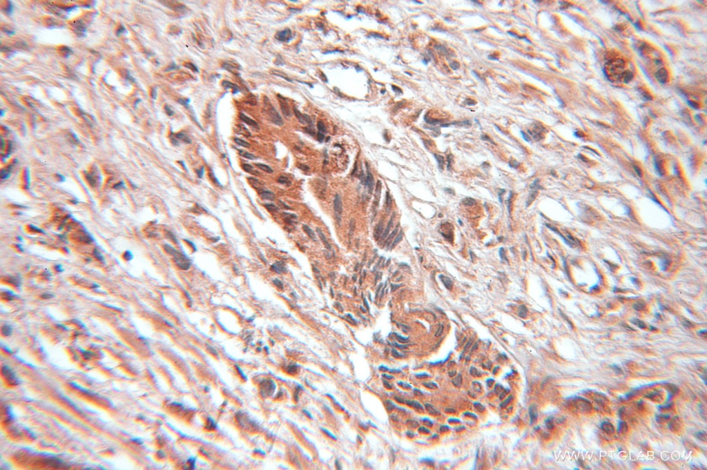 Immunohistochemistry (IHC) staining of human prostate cancer tissue using SRP9 Polyclonal antibody (11195-1-AP)