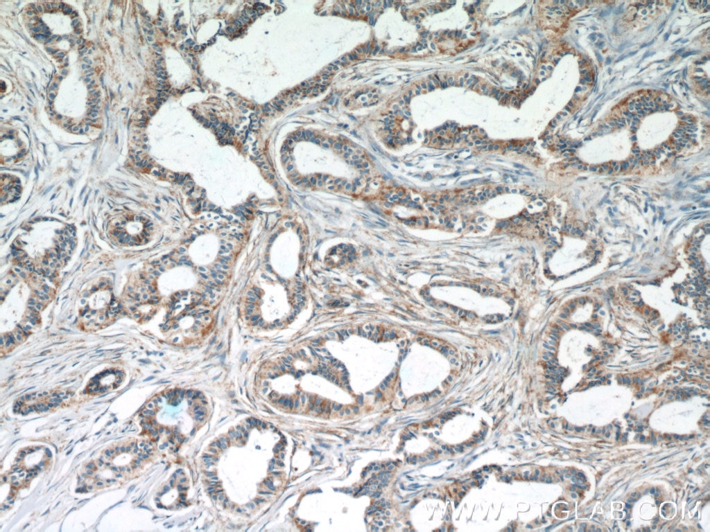 Immunohistochemistry (IHC) staining of human breast cancer tissue using SRPK1 Polyclonal antibody (14073-1-AP)